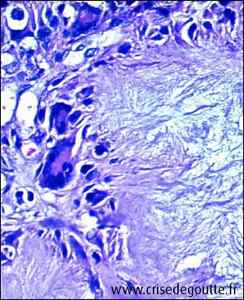 Microcristaux d'urate